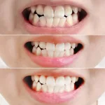 Phân phối kem Đánh Răng Median Màu Đỏ Dental IQ 93% Tartar Toothpaste Badbreath 120g