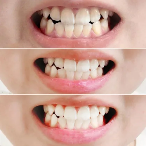 Phân phối kem Đánh Răng Median Màu Đỏ Dental IQ 93% Tartar Toothpaste Badbreath 120g