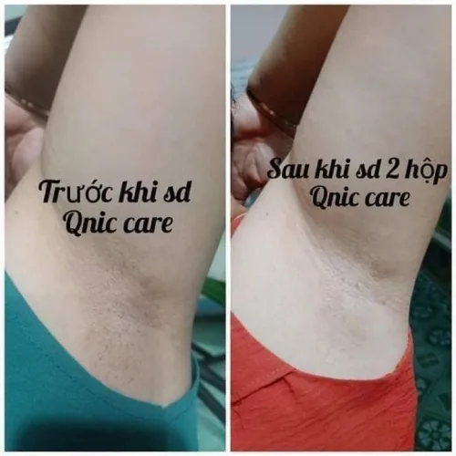 Kem Giảm Thâm Nách Q Nic Care Thái Lan Phiên Bản Mới