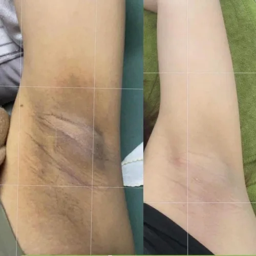 Kem Giảm Thâm Nách Q Nic Care Thái Lan Phiên Bản Mới
