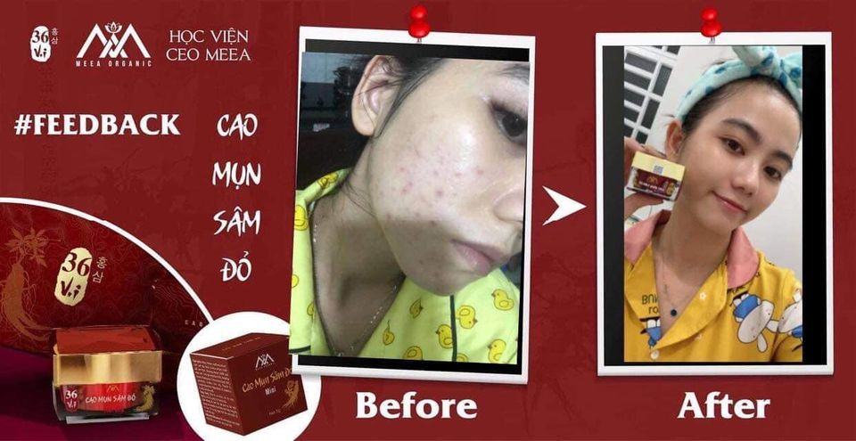 Cao Mụn Sâm Đỏ 36 Vị Thuốc Bắc - Vua Trị Mụn An Toàn