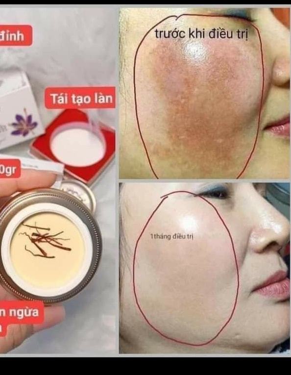 Feedback Kem Trị Nám Dưỡng Trắng Da Saffron Napoli Hải Âu Việt