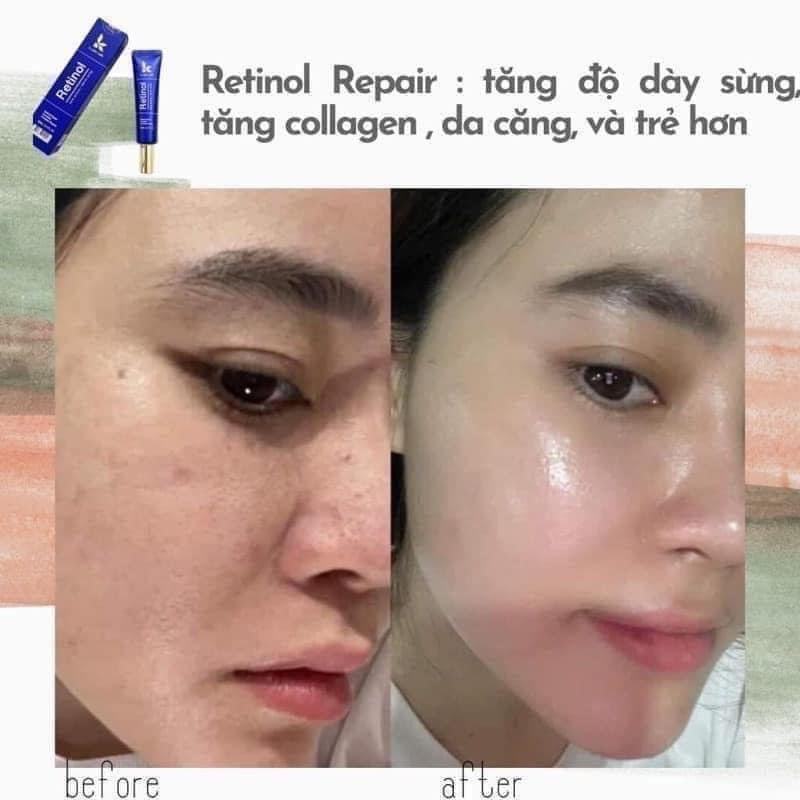 Giờ mà chưa biết Retinol K Lady thì đúng là hối tiếc suốt đời luôn á