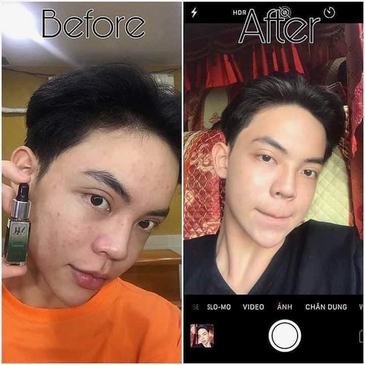DR MAI KHẮC TINH CỦA CÁC LOẠI MỤN