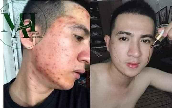DR MAI KHẮC TINH CỦA CÁC LOẠI MỤN