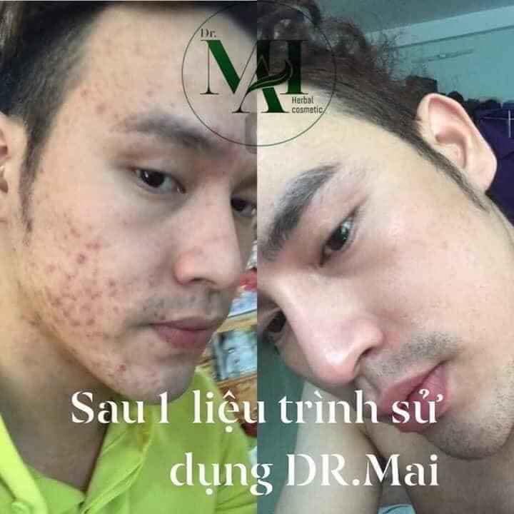 DR MAI KHẮC TINH CỦA CÁC LOẠI MỤN