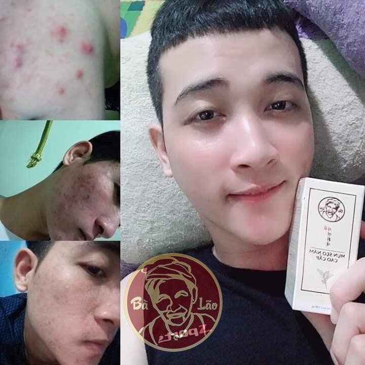 TRỊ MỤN BÀ LÃO - sản phẩm thảo dược thiên nhiên