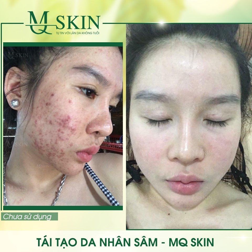 Vì sao "BB Cream tái tạo da MQ Skin" gây siêu bão trên thị trường?