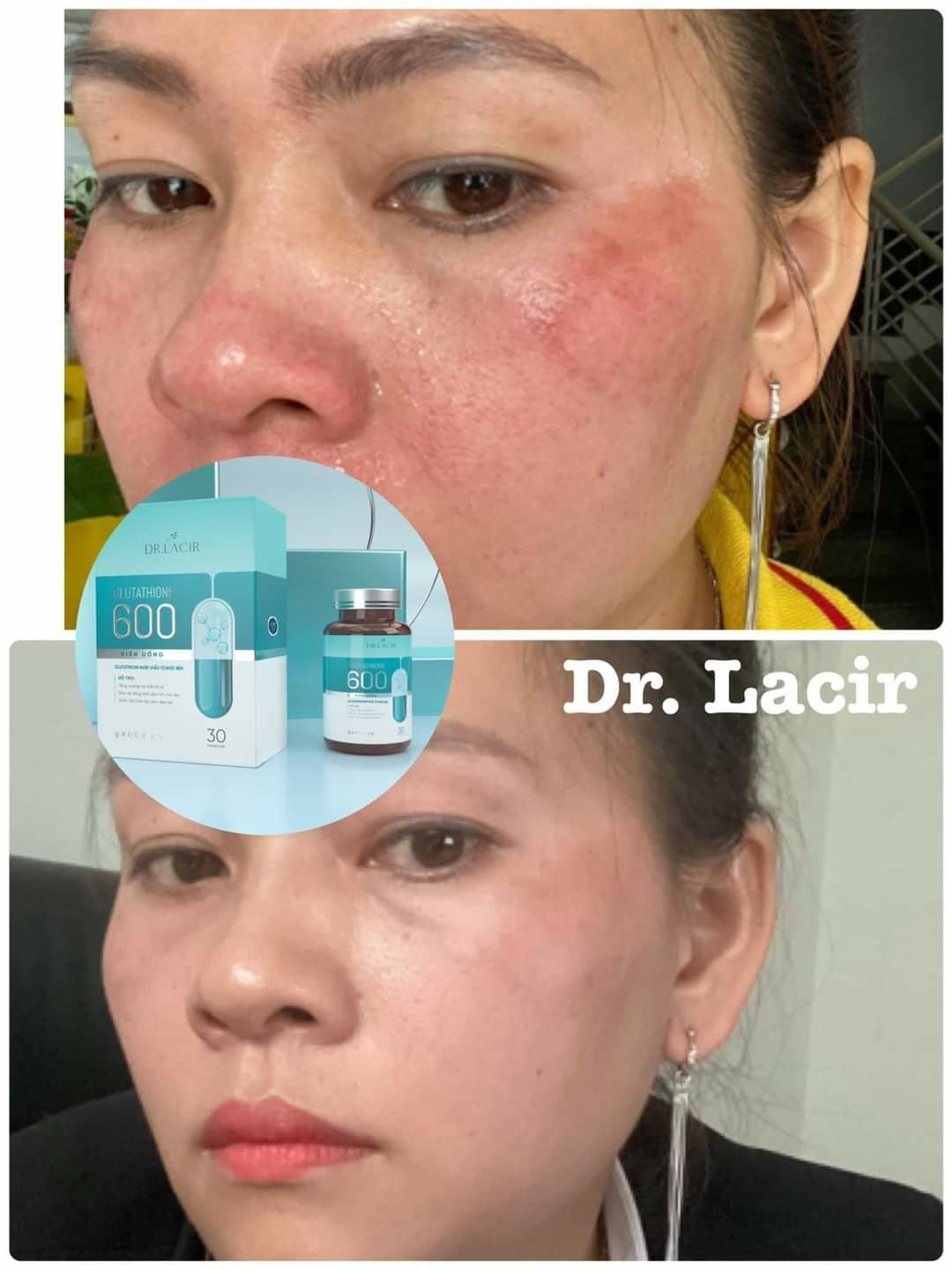 🌟 Giảm nám da với viên uống trắng da Dr Lacir không cần laser