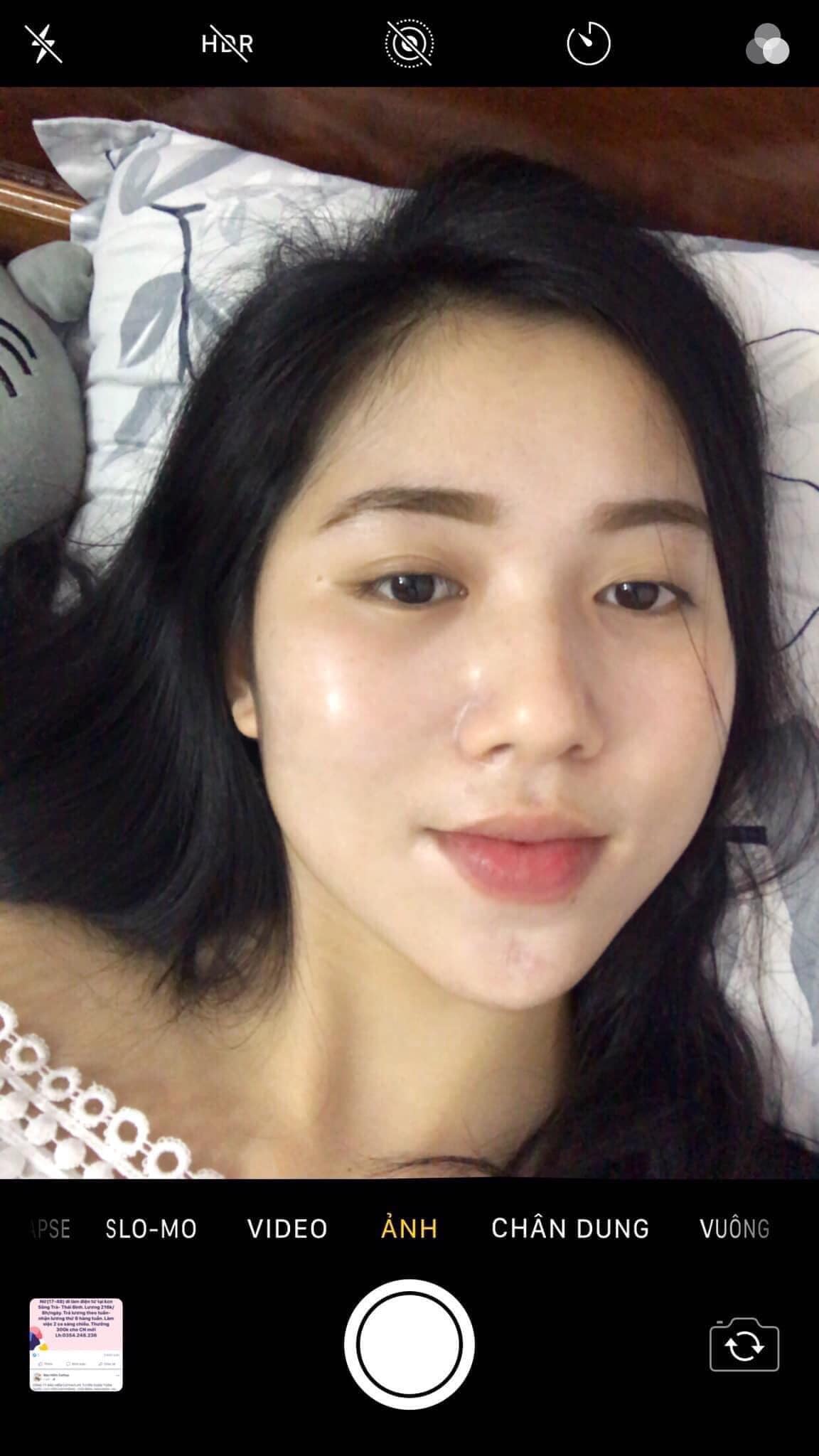 Không thử thuốc này sẽ không bao giờ biết khi nào da mặt mới được sạch mụn