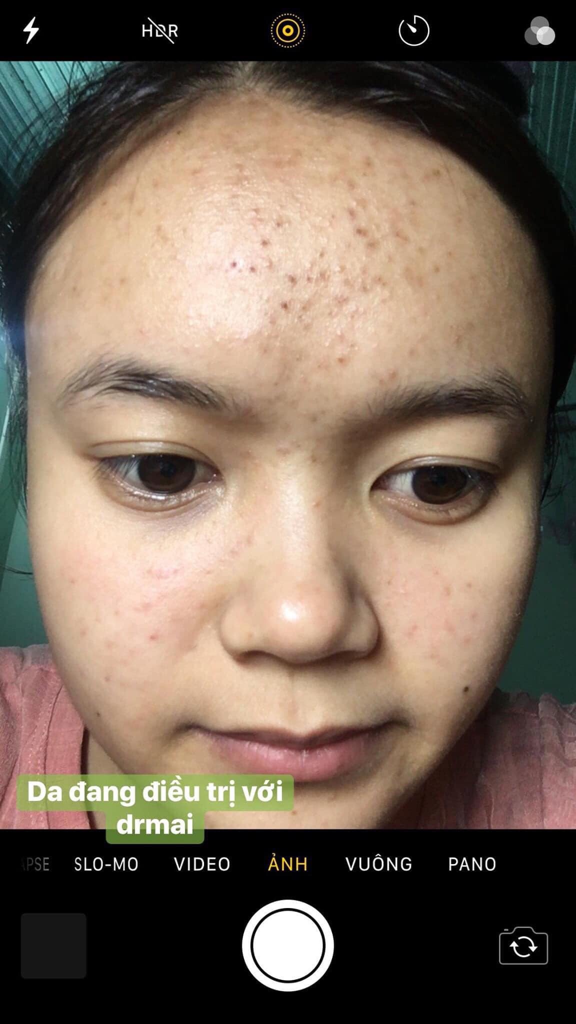 Phụ nữ muốn đẹp phải siêng, đừng lười biếng để mặt đầy mụn