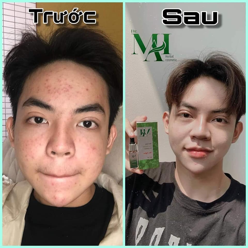Siêu trị mụn thần thánh DR Mai