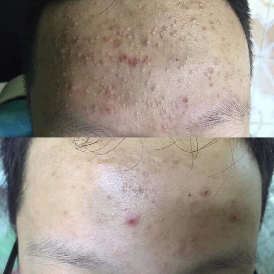 Siêu trị mụn thần thánh DR Mai