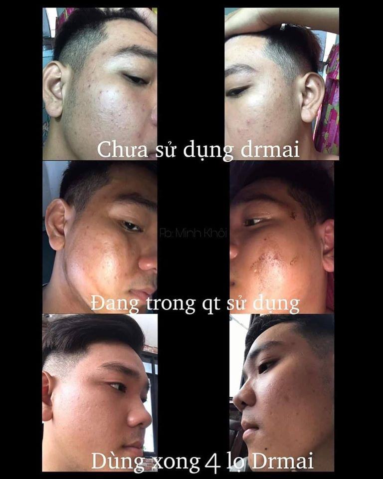 Trị mụn DR Mai vừa hợp túi tiền - vừa an toàn hiệu quả