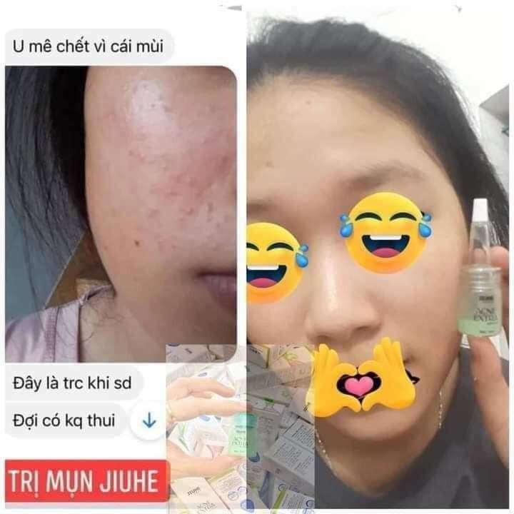 Tại sao tôi khuyên bạn nên dùng Jiuhe Acne Extra để trị mụn