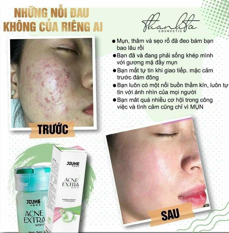 Sạch mụn liền tay có ngay Jiuhe Acne Extra