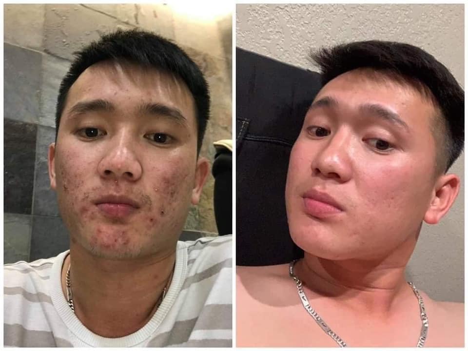 DR MAI trị mụn cho nam