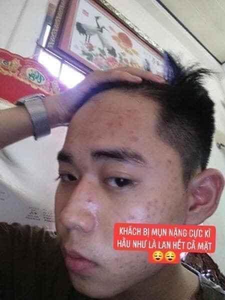 DR MAI trị mụn lành tính