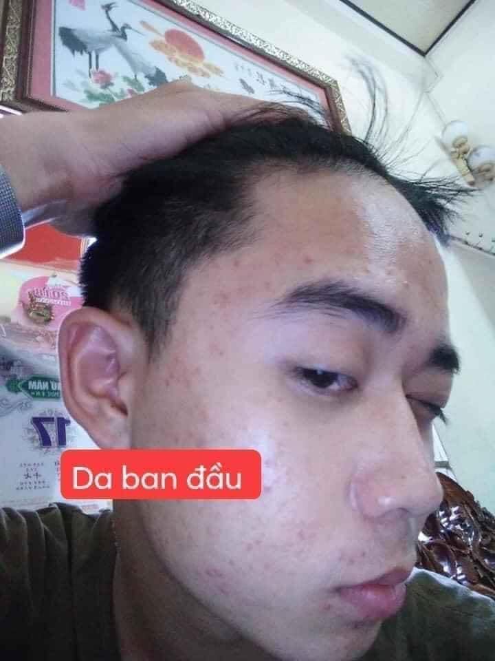 DR MAI trị mụn lành tính